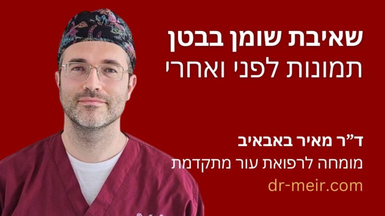 שאיבת שומן בבטן לפני ואחרי - דר מאיר באבאיב מומחה לרפואת העור מתקדמת רופא עור