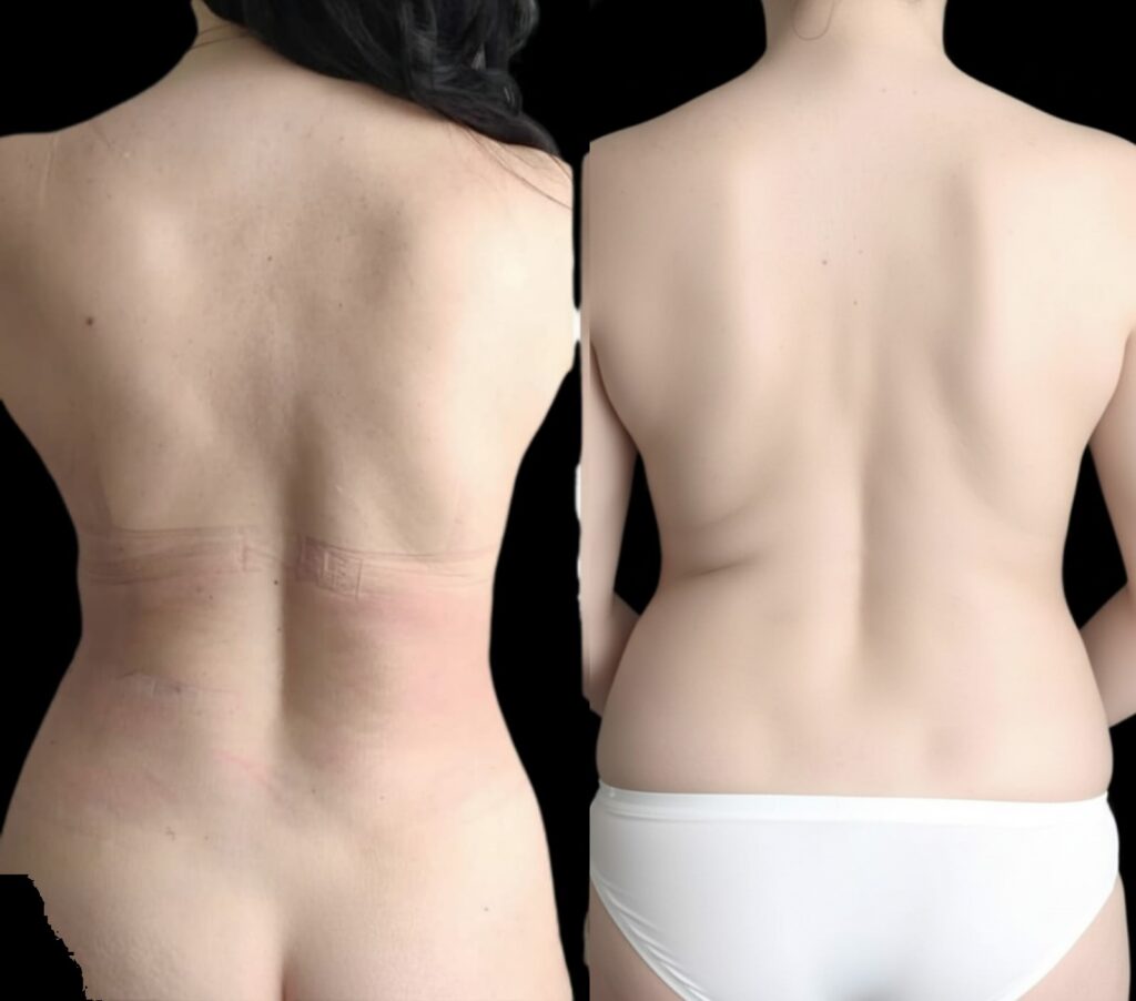 BodyTite שאיבת שומן ומיצוק עור בגב התחתון ובמותניים — 10 ימים אחרי הטיפול, ד״ר מאיר באבאיב