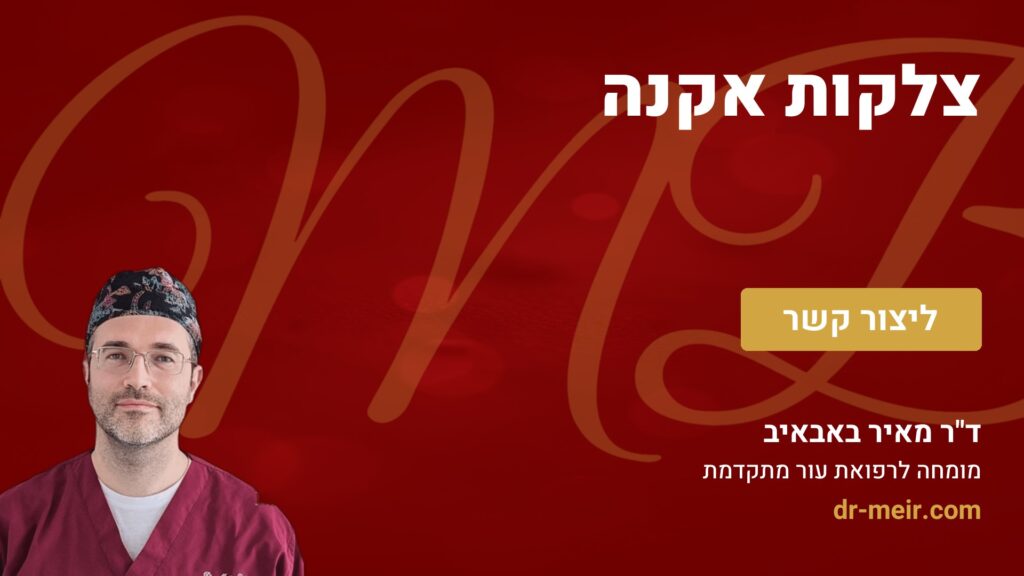צלקות אקנה - דר מאיר באבאיב