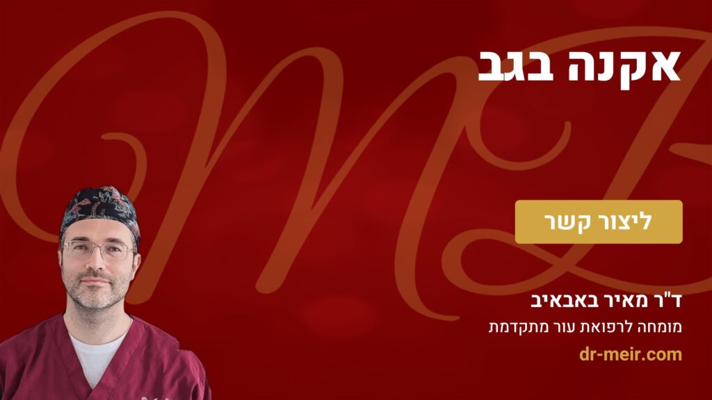 אקנה בגב - דר מאיר באבאיב