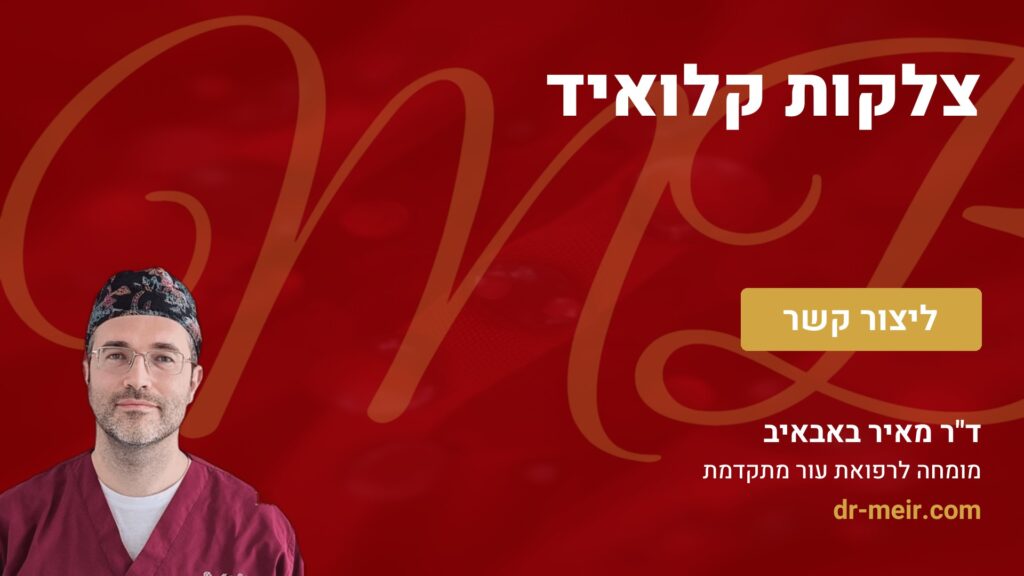 צלקות קלואיד - דר מאיר באבאיב