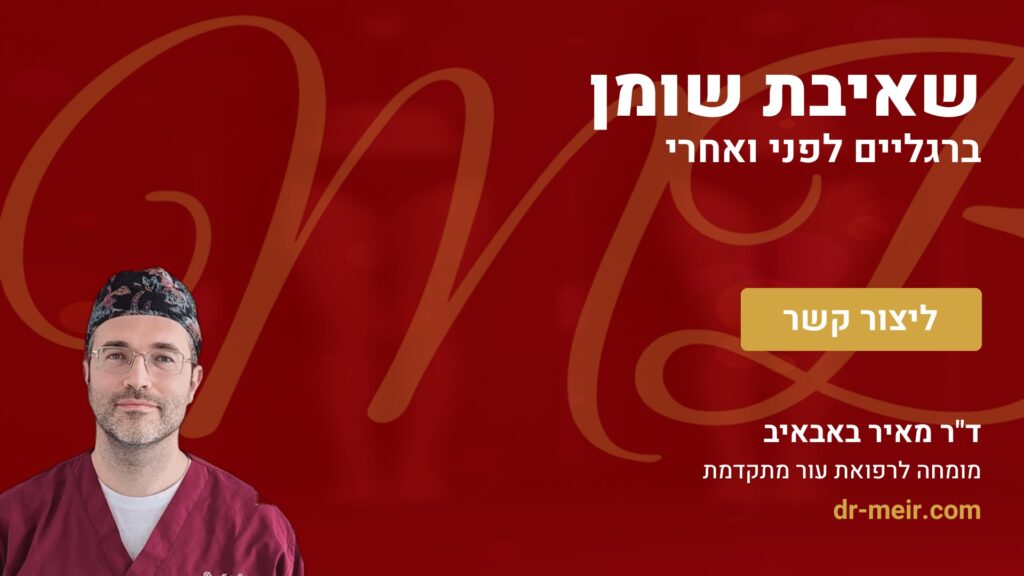 שאיבת שומן ברגליים לפני ואחרי - דר מאיר באבאיב