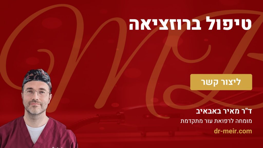 טיפול ברוזציאה - דר מאיר באבאיב