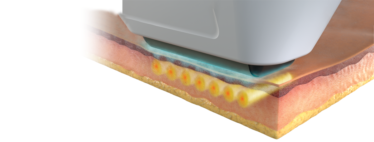 Sofwave לעומת HIFU, RF Microneedling ו-Thermage: השוואת טכנולוגיות מיצוק עור ראש הטיפול של Sofwave מונח על העור