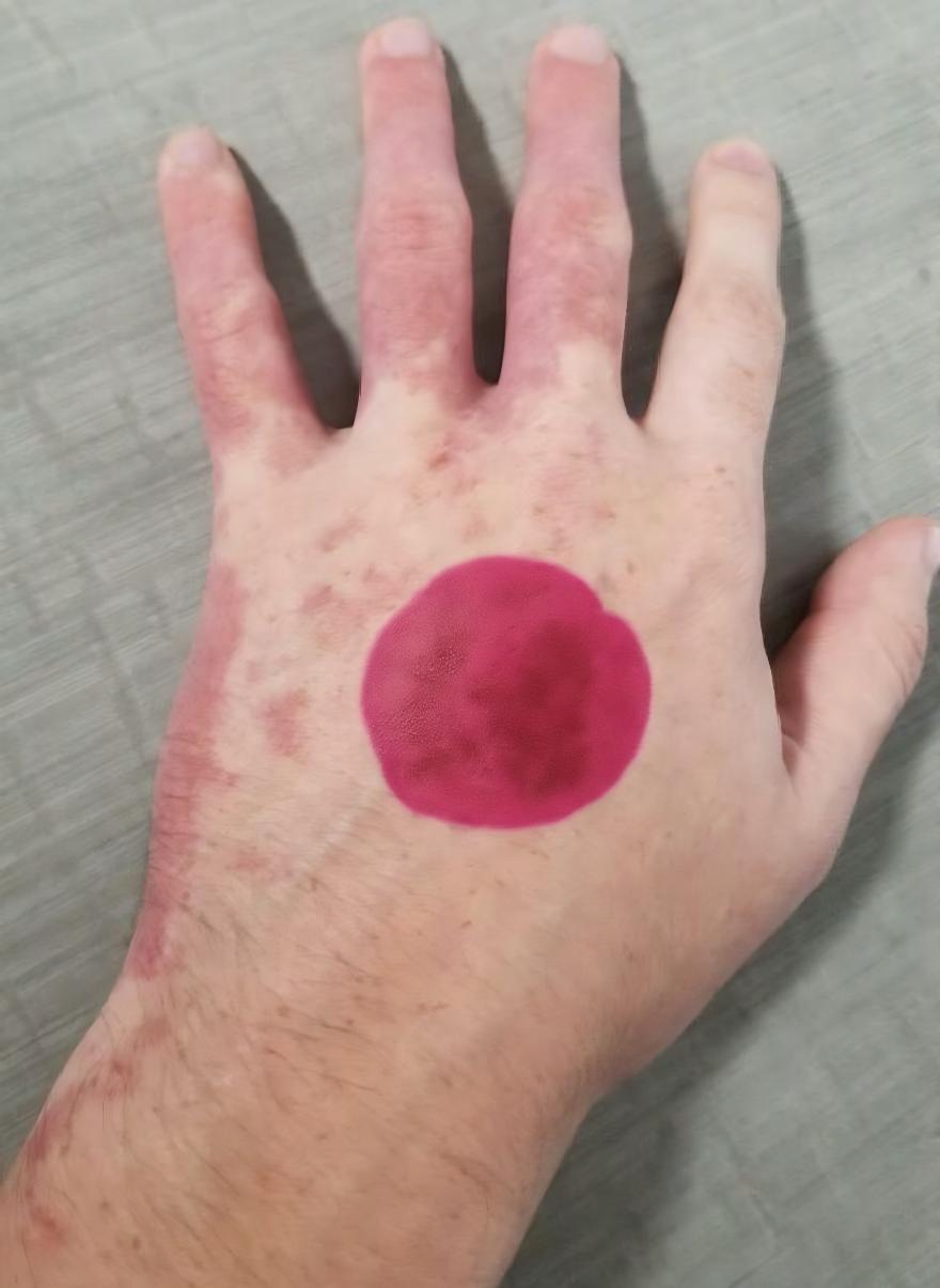 כתם יין (Port Wine Stain): טיפול בלייזר בכתם הלידה הוורוד תצלום קליני של כתם יין ורוד־אדום שטוח על גב כף היד, מום כלי דם נימי