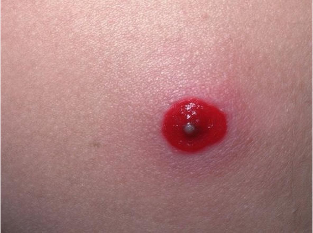 שחין, מורסות וסחור (stye): זיהומי עור והטיפול בהם תקריב קליני של שחין בודד אדום ומודלק עם ראש מרכזי על עור תקין מסביב