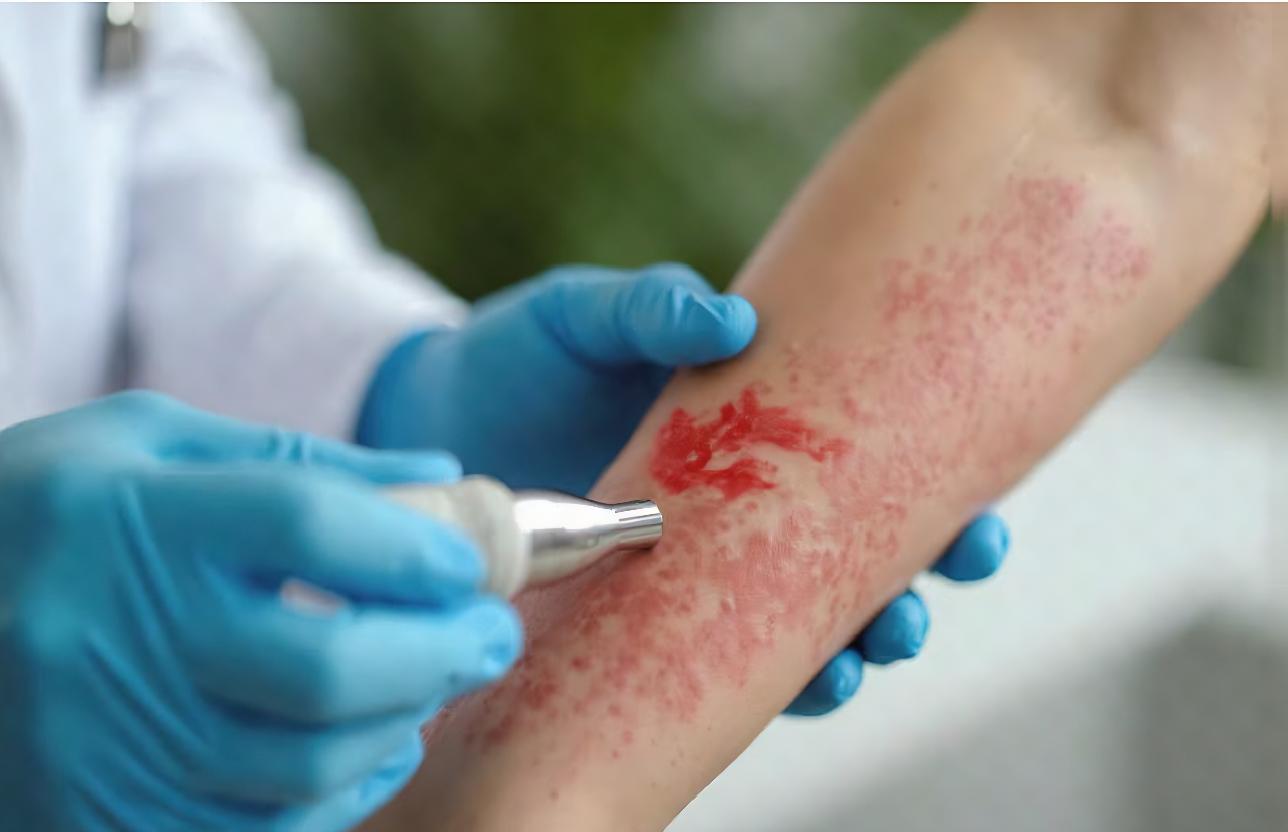 שחין, מורסות וסחור (stye): זיהומי עור והטיפול בהם רופא עור בודק זיהום עור דלקתי בזרוע המטופל במרפאה
