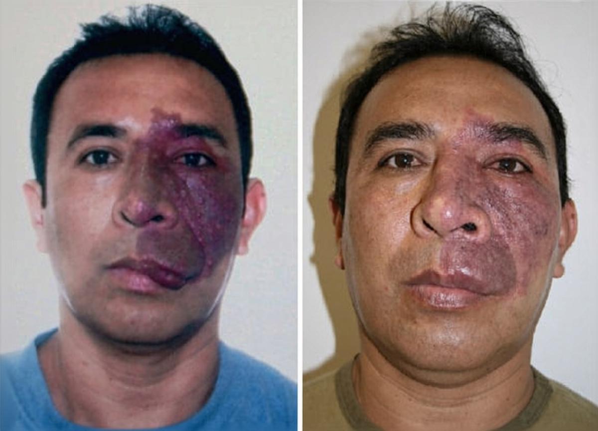 כתם יין (Port Wine Stain): טיפול בלייזר בכתם הלידה הוורוד כתם יין ורוד-סגול על הלחי, סימן הלידה הוסקולרי שמטופל בלייזר צבע פועם