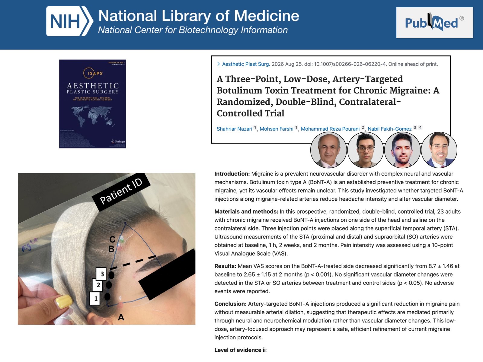 רשומת PubMed של המחקר על טיפול בוטוקס בשלוש נקודות לאורך העורק הטמפורלי במיגרנה כרונית