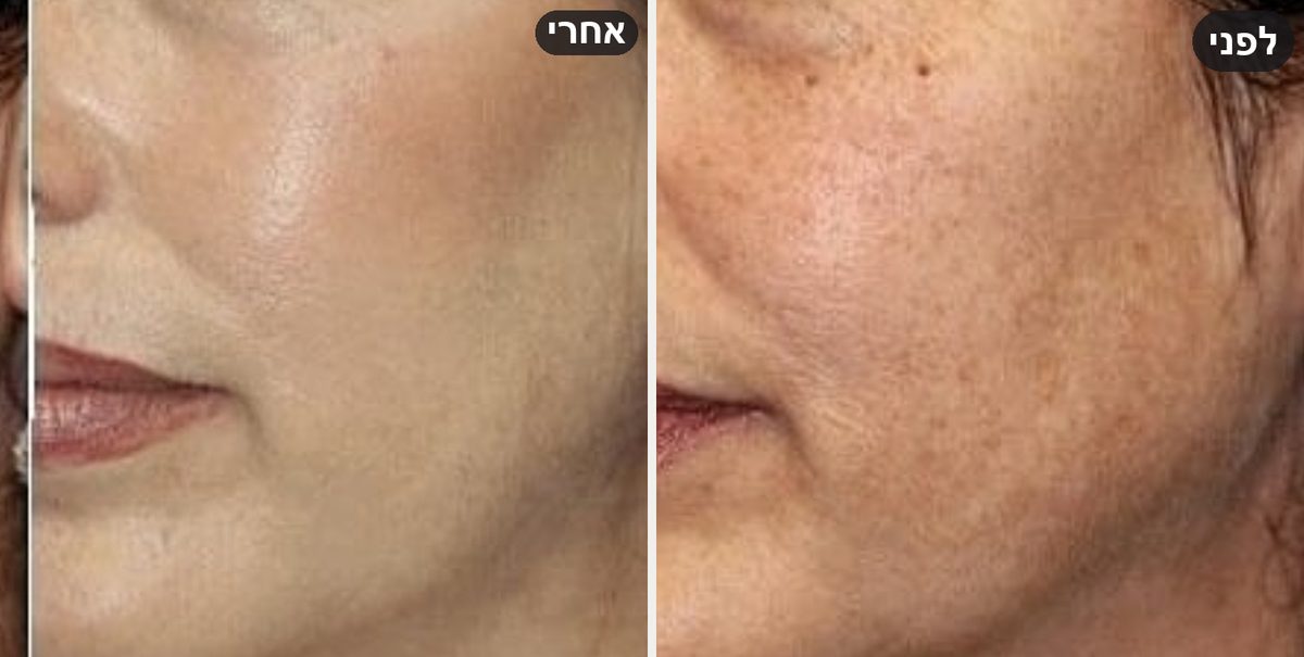 הסרת כתמי פיגמנטציה בלחי — לפני ואחרי