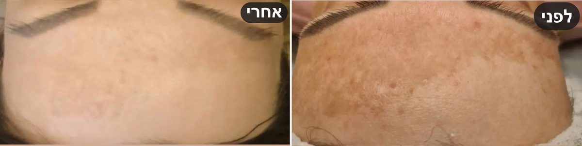 טיפול במלזמה במצח — לפני ואחרי