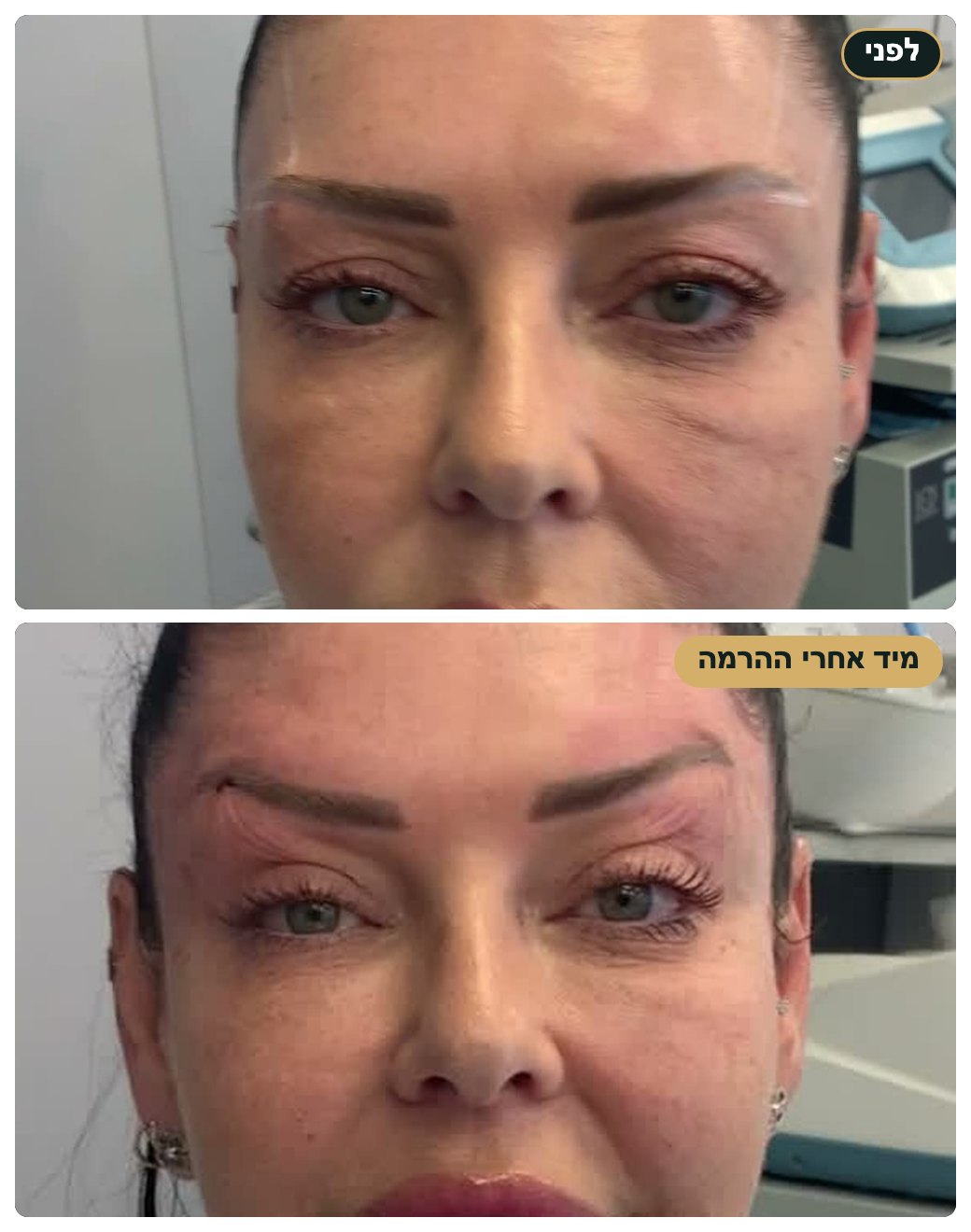 הרמת גבות בחוטים, לפני ומיד אחרי הטיפול