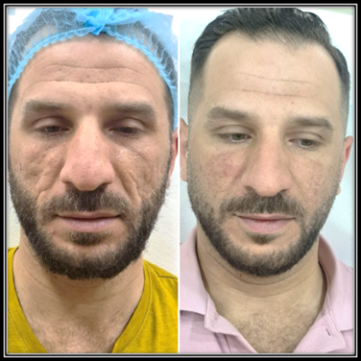 הזרקת קולגן לשיפור צלקות אקנה